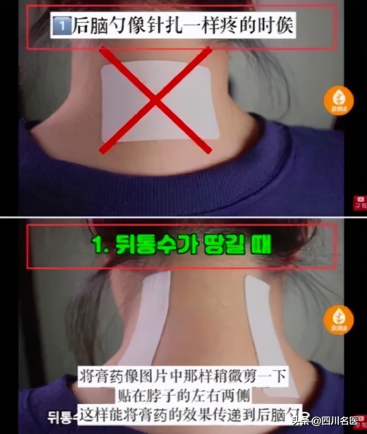 哪儿疼贴哪儿,膏药是不是哪儿疼贴哪儿