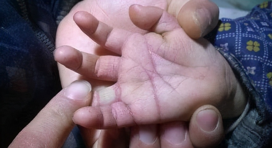 新生儿湿疹怎么预防最佳方法,新生儿怎么预防湿疹最好方法