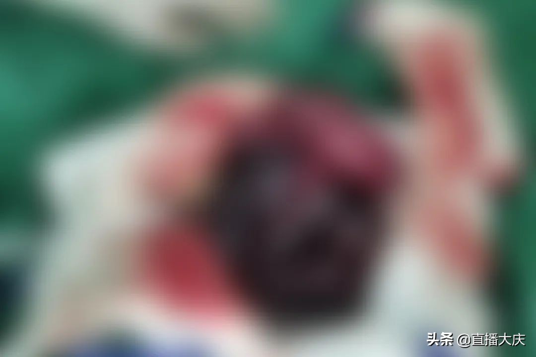 儿童小肠切除了大部分还会长吗,孩子小肠切掉4cm一截有什么影响