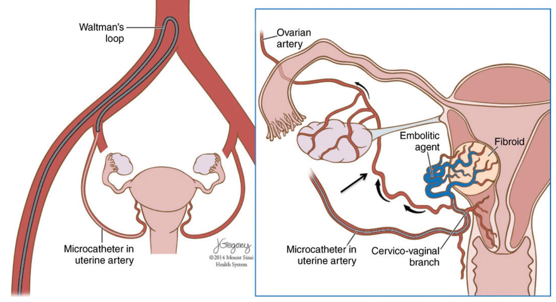 子宫肌瘤的位置、大小对介入栓塞疗效有何影响？