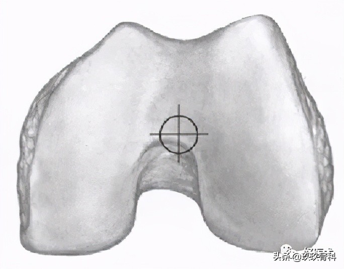 髓内钉技巧,髓内钉教学视频讲解