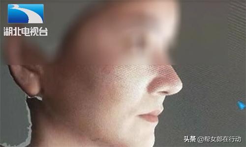 假体耳软骨隆鼻六天伤口流脓,花费近三万元隆鼻鼻子竟然变歪了