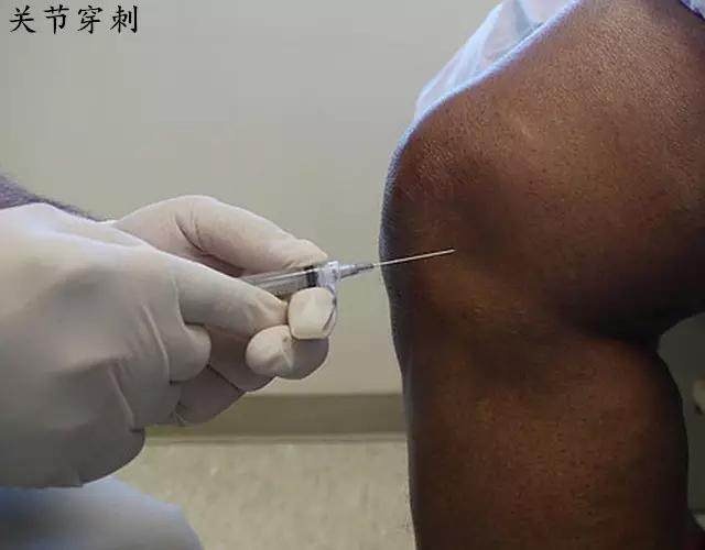 膝关节滑膜炎肿胀积水原因,膝关节滑膜炎积水了肿胀怎么办