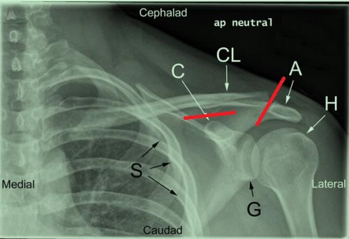 肩锁关节脱位复位视频,肩锁关节脱位固定带