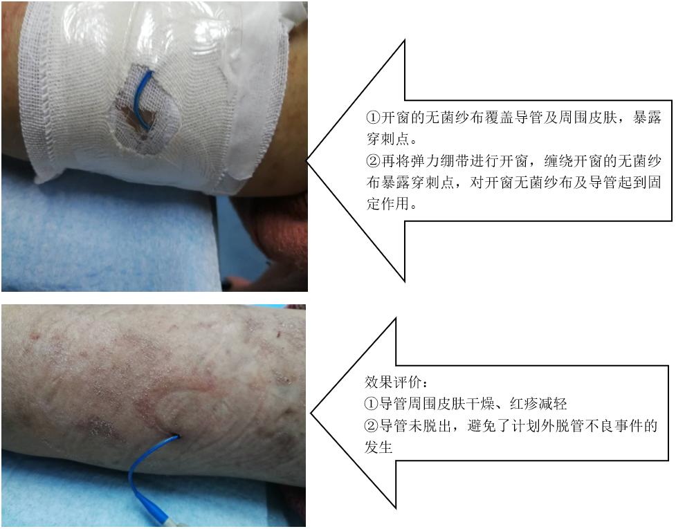 picc敷贴旁边长了小水泡,picc导管贴膜维护教学视频