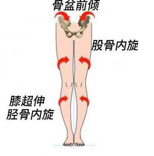 膝反屈的治疗方法,膝反屈是什么意思