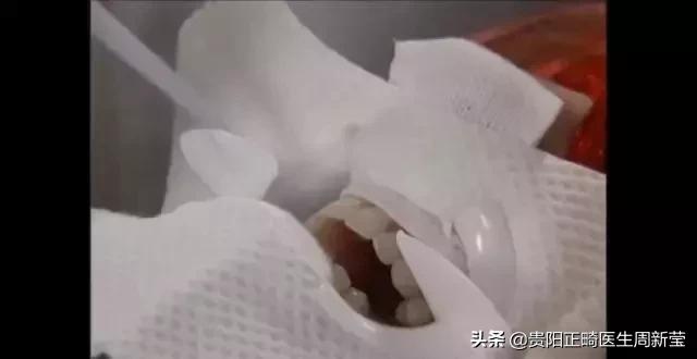 市面上冷光美牙仪真的有用吗,蓝光美白牙仪真的管用吗