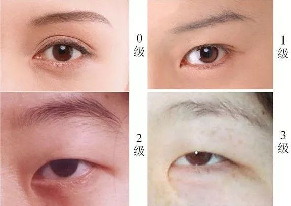 新生儿青色皮肤是不是胎记,新生儿青斑是中国人才有的吗