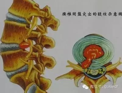 协和骨科博士谈腰椎间盘突出症的保守治疗方案，非常实用