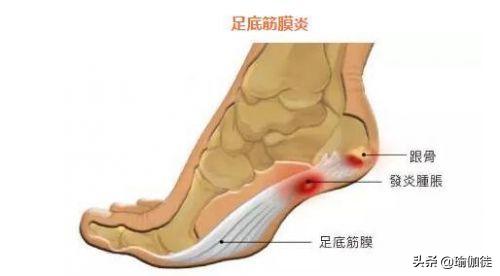 足底筋膜炎练什么瑜伽姿势好,哪些瑜伽体式加强足底训练