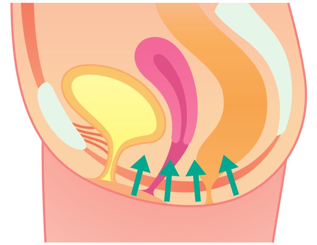 盆底肌训练器材可以改善漏尿吗,改善盆底肌漏尿
