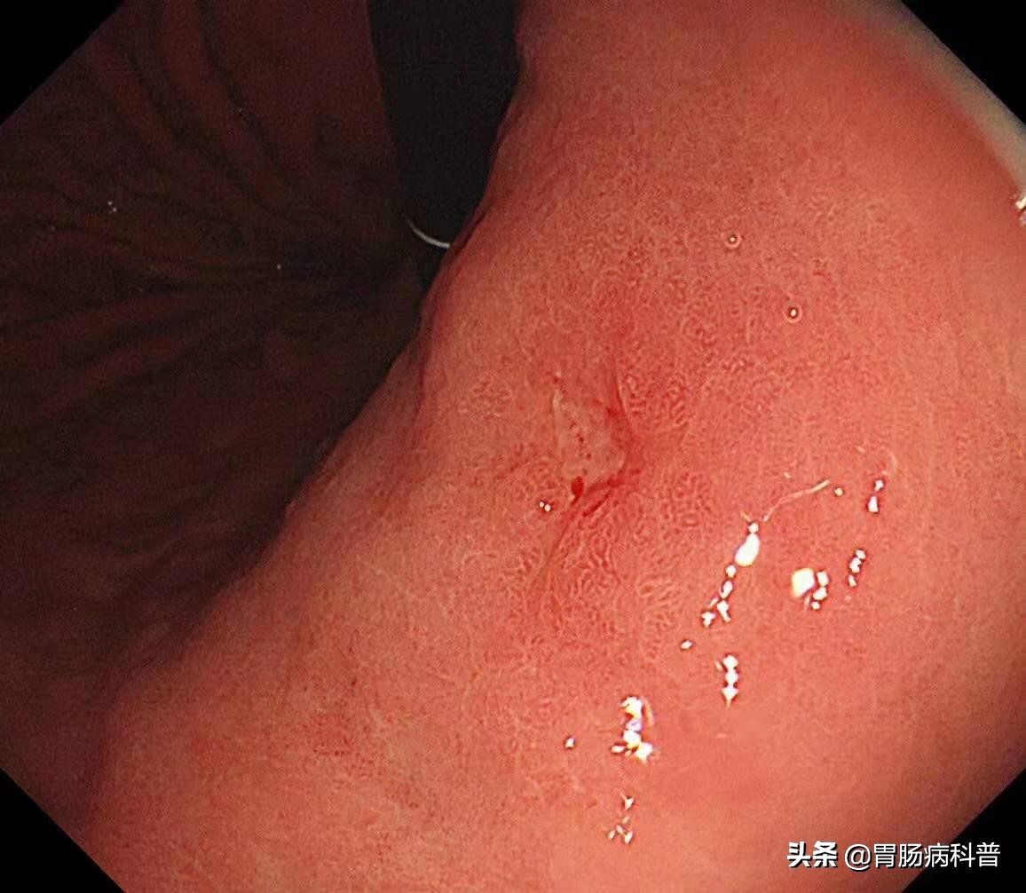 幽门螺杆菌到底该不该治,幽门螺杆菌是不是一定要根除