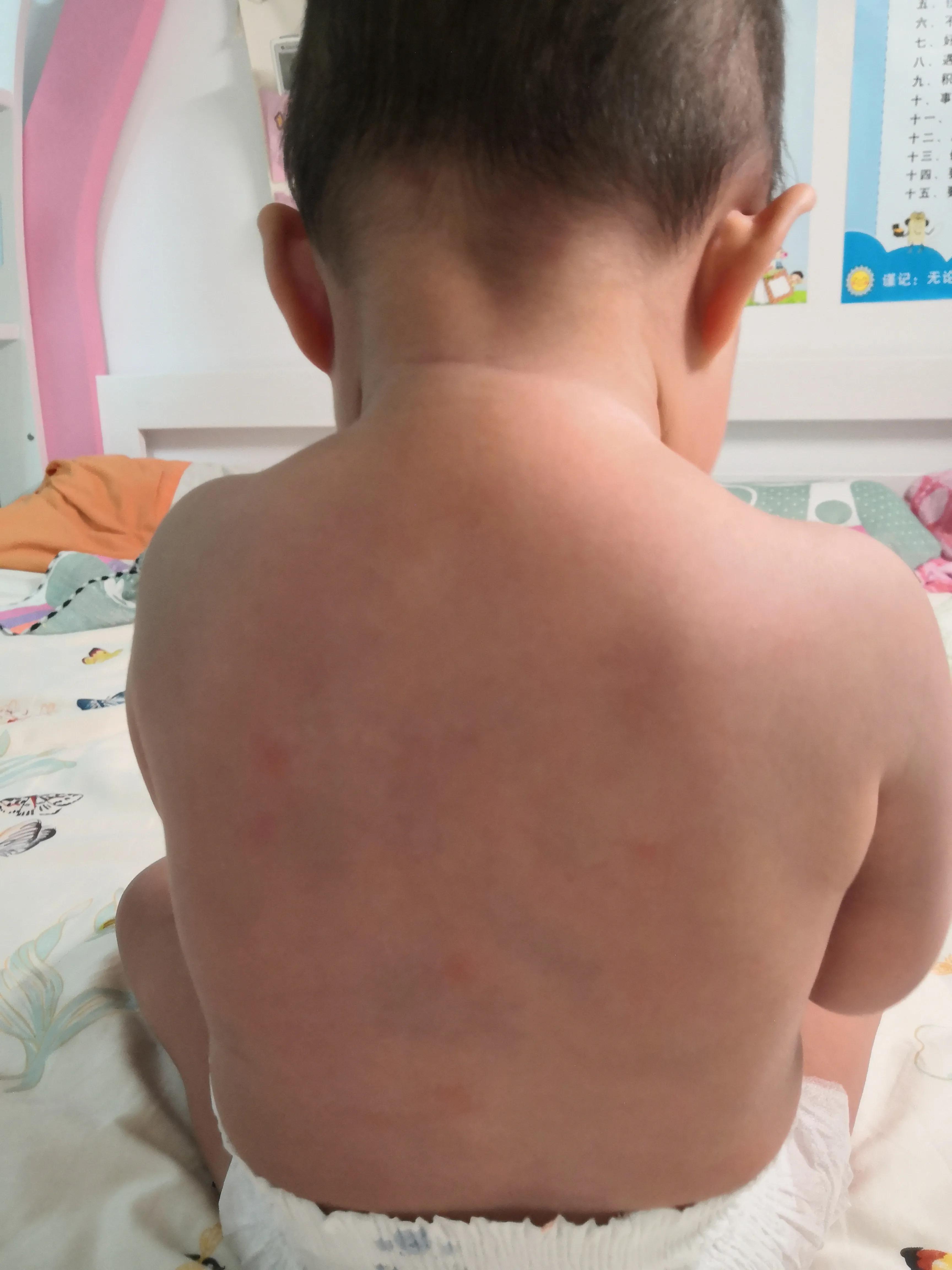 宝宝急疹疹子出来后要注意什么,婴幼儿急疹出疹子后能不能洗澡