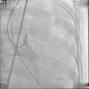 BAV遭遇心脏突然停跳，Sapien3快速植入挽救患者生命