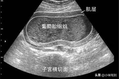 怀孕一定要提防什么病,怀孕引起的葡萄胎有什么症状