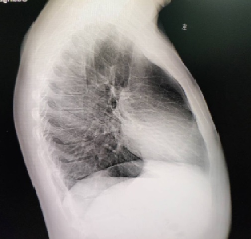 今天的Wenlin手术：桶状胸的微创矫治手术