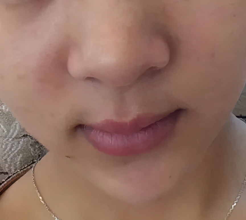 蒜头鼻怎么自己矫正,蒜头鼻塌鼻梁朝天鼻怎么改善