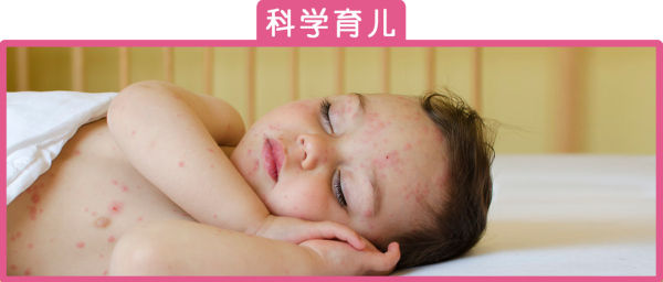 宝宝脖子上的痱子起脓包,痱子发红是快好了吗