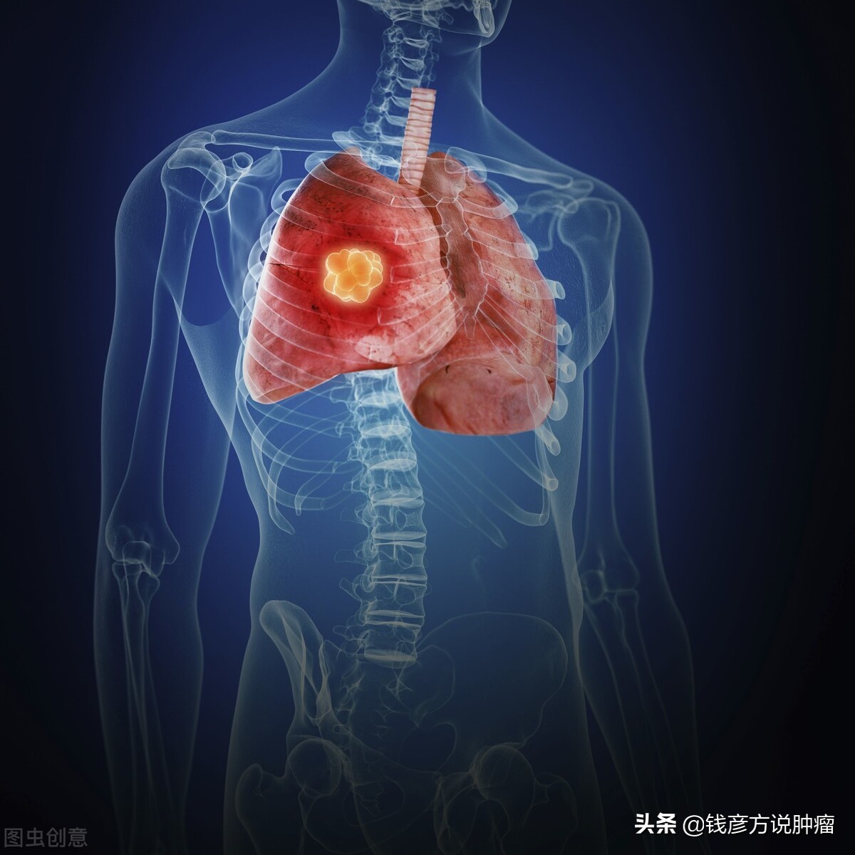 肺癌患者脑部转移，靶向药和中药结合治疗，持续治疗5年生活如常