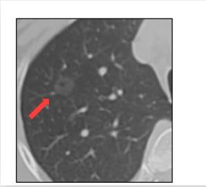 磨玻璃肺结节17mm要不要马上手术,7毫米肺磨玻璃结节要不要切除