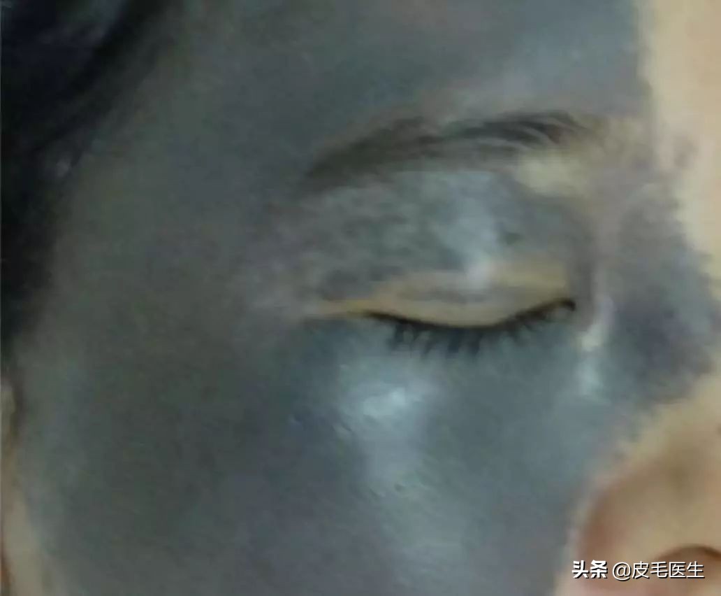 褐斑祛斑最有效方法,年轻人脸上长褐斑老年斑如何治疗