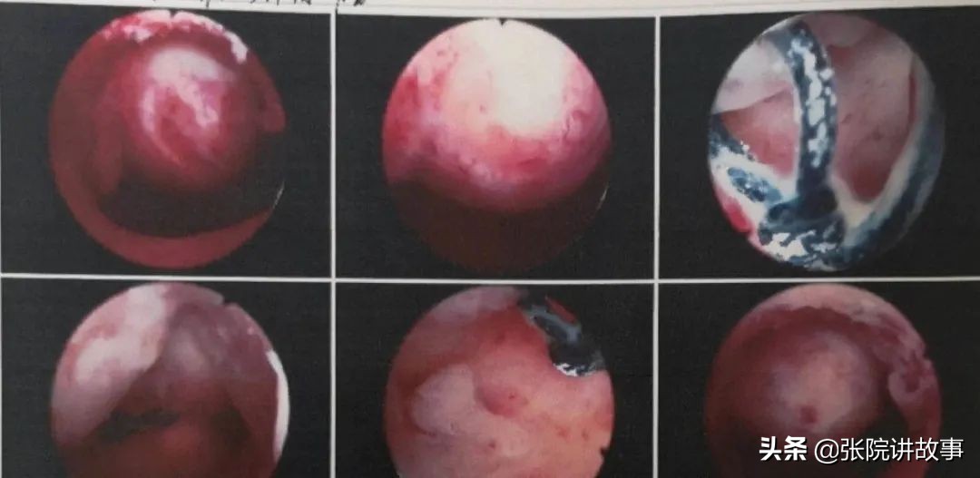 「张院讲故事」子宫肌瘤：名中带“瘤”，真的非常可怕吗？