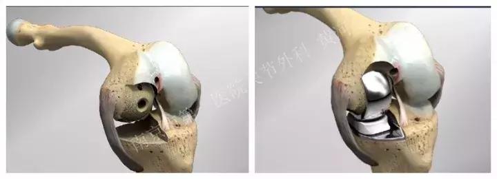 关于膝关节疼痛你一定有好多疑问,类风湿性关节炎患者常见问题解答