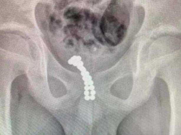 10岁女孩往*体下**塞东西，宝妈发现后慌忙送医，孩子：觉得好玩而已