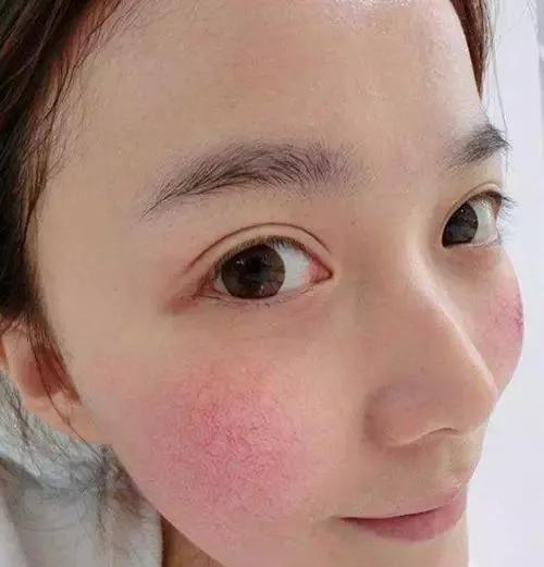 红血丝如何修复掌握四招轻松应对,有效消除红血丝