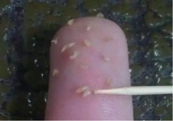 脸上小米粒疙瘩是什么问题,脸上长了白色的小米粒图片