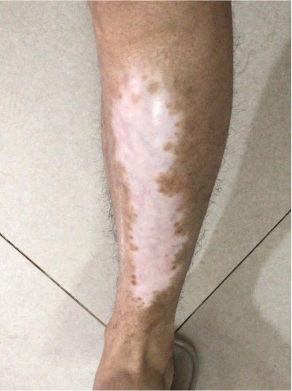 适合男士遮盖腹部白癜风的纹身,山东白癜风纹身遮盖