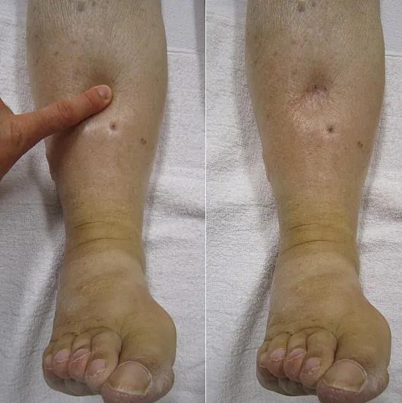 糖友泡沫尿,糖友尿中泡沫多是尿蛋白吗