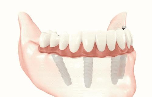 日照口腔医院种牙价目表,日照口腔医院种植牙价目表