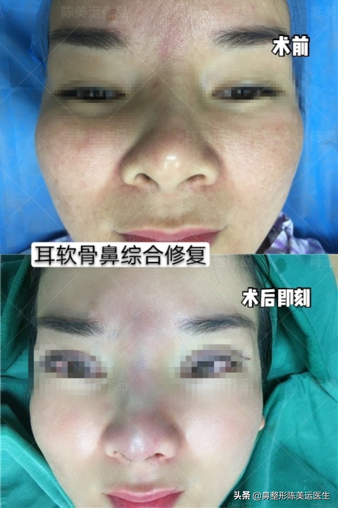 假体隆鼻后鼻子变歪该如何处理,假体隆鼻透光如何处理