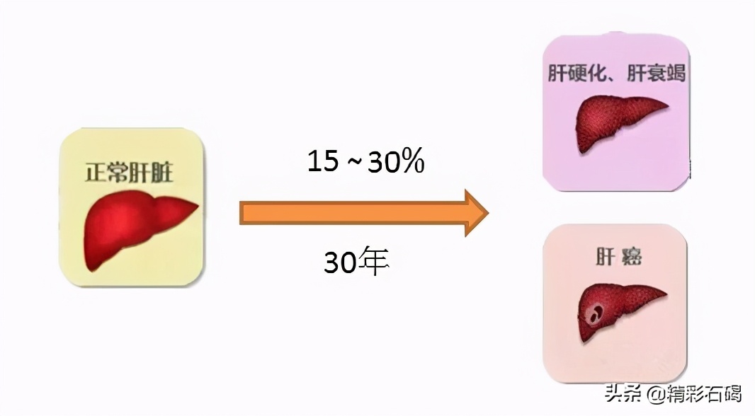 治疗丙肝国家有补助吗,治疗丙肝有优惠政策吗