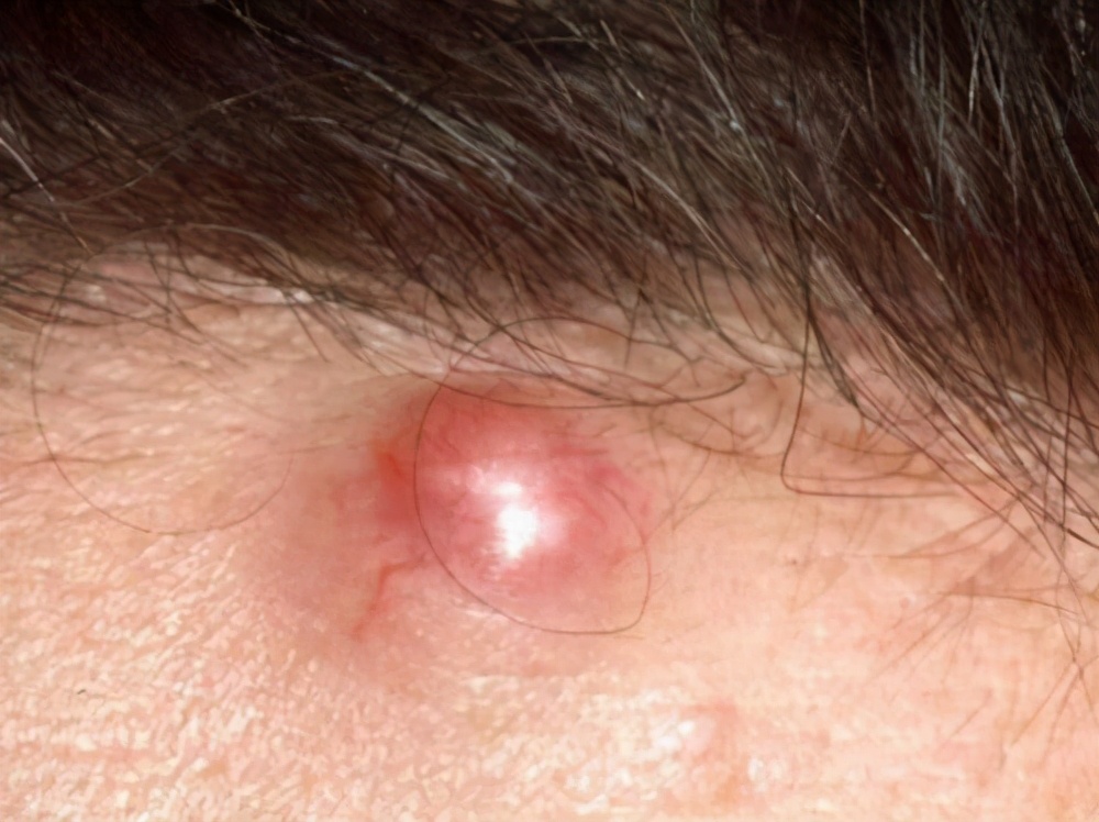 枕部表皮囊肿是怎么回事,表皮囊肿是如何形成的呢