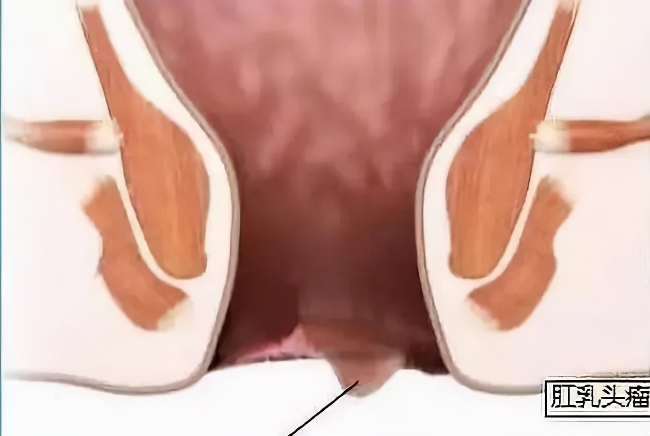 肛门总有撕裂感,肛门处条状物