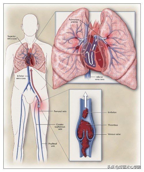 最常见的血栓类型是,最致命血栓视频