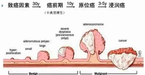 结直肠腺瘤是癌吗?肠腺瘤该如何治疗?