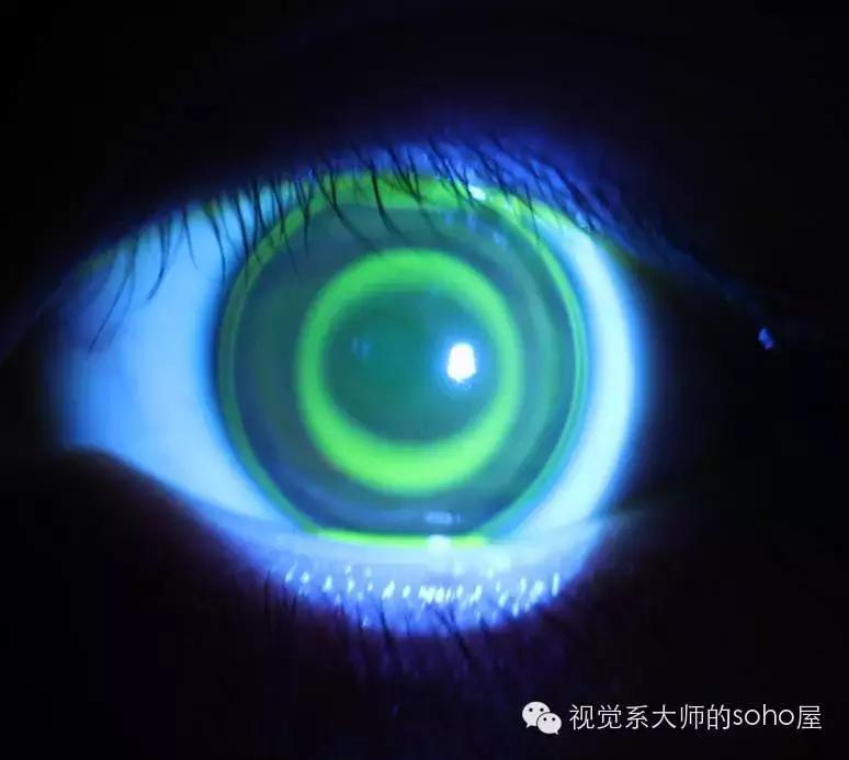 如何选择角膜塑形镜的品牌,怎么选角膜塑形镜的参数