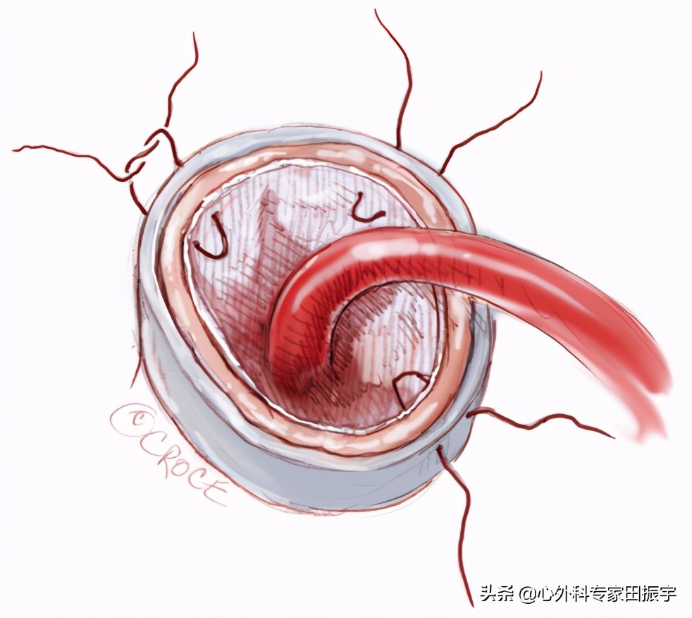 急性B型主动脉夹层合并主动脉破裂的急诊处理
