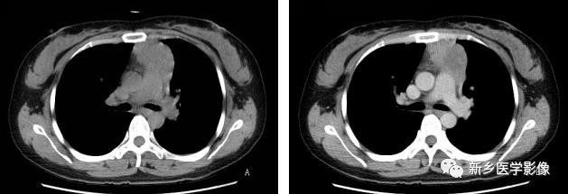 前上纵隔高密度影考虑胸腺未退化,肺纵隔胸腺结节12mm看什么科