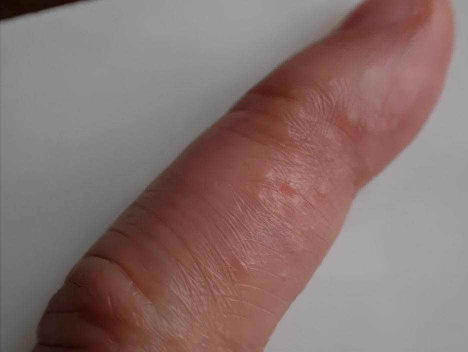 经常听人说湿气重到底湿气是什么,常说的湿气重是什么