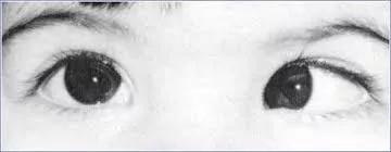 弱视治疗经验分享,弱视治疗的正确方法