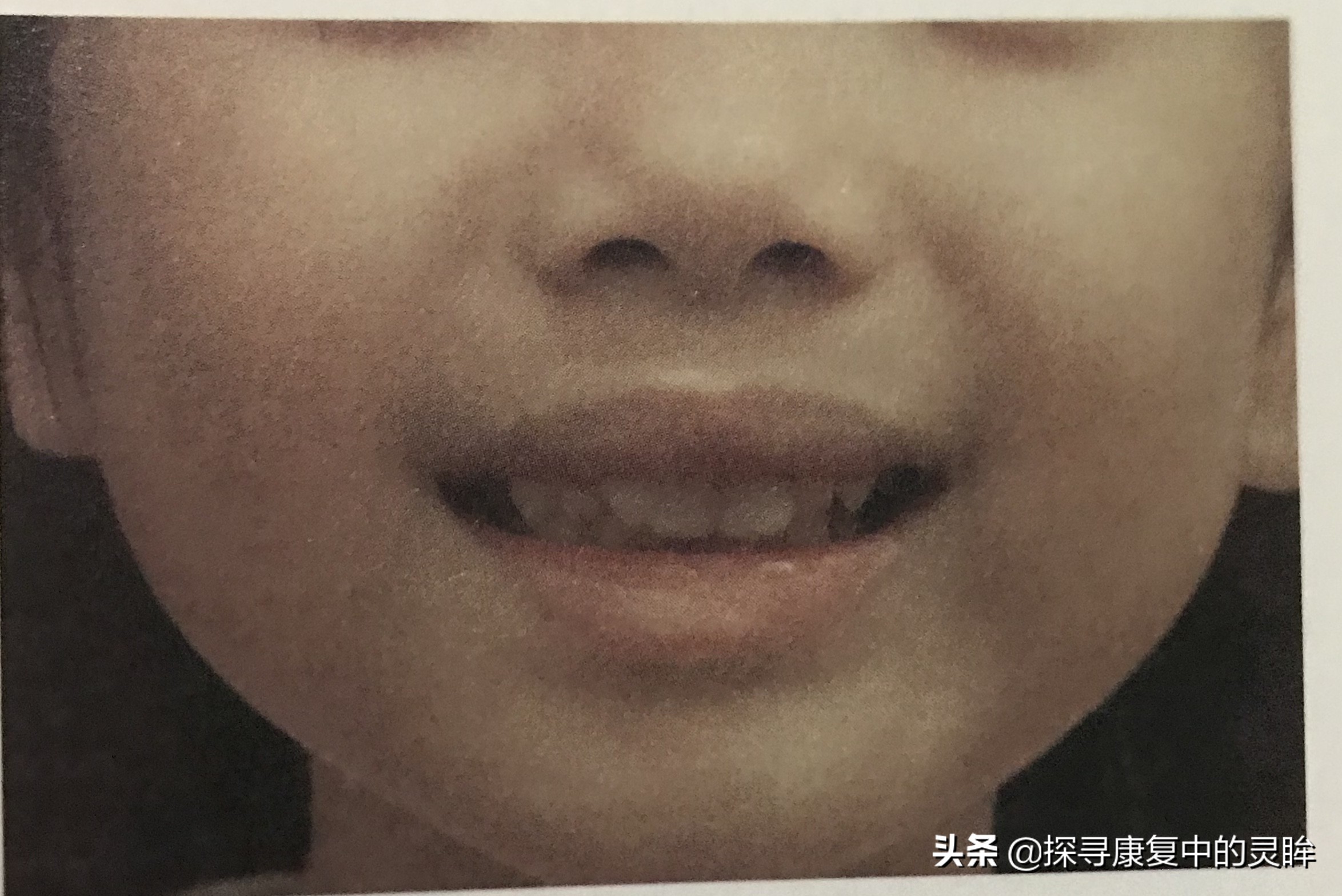 五种口部运动：灵活孩子的樱桃小嘴，让他们说话更清晰（超简单）