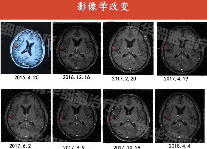肺癌晚期活不了多久的症状,肺癌晚期生命只剩下六个月