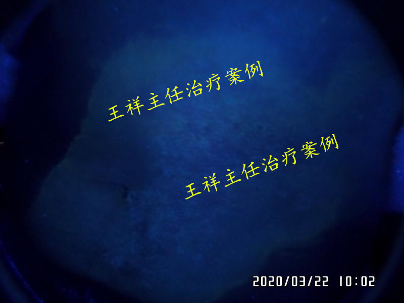 白癜风黑色素种植效果好吗,黑色素种植治疗白癜风费用