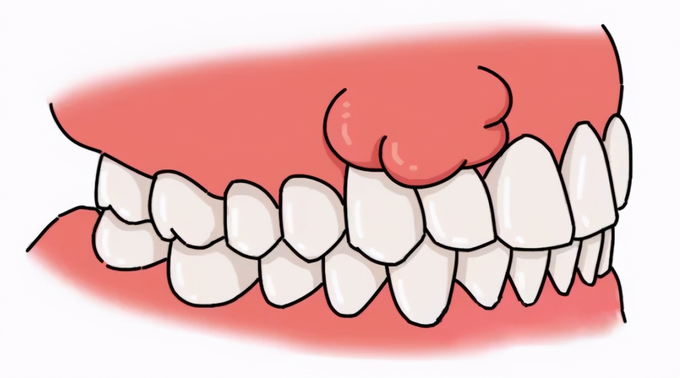 怀孕期间能种植牙齿吗,孕妇种牙还是戴牙套