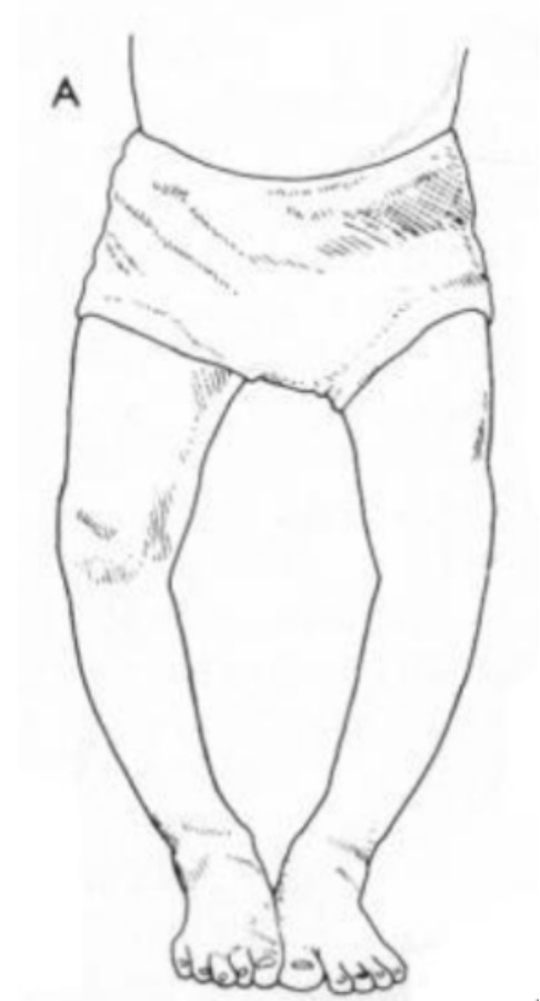 儿童肘内翻畸形,遗传右膝外翻畸形