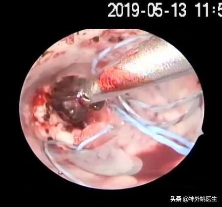 微创手术后血肿是什么,颅内血肿微创清除术多少钱